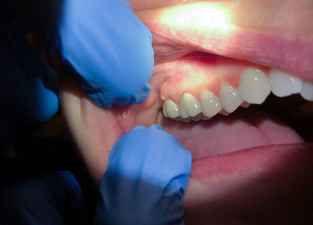 Best Emergency Dental Extractions in Westlake Vlage, IL